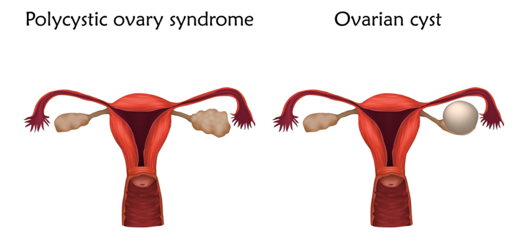 Ovarian cysts causes symptoms and treatment