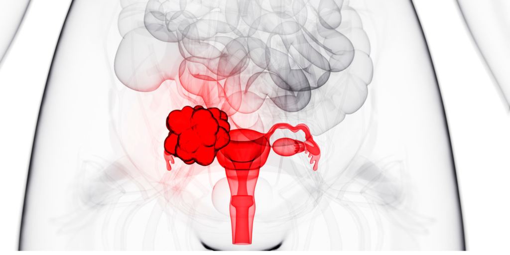 Ovarian cysts causes symptoms and treatment