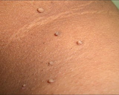Moles, Freckles, Skin Tags,