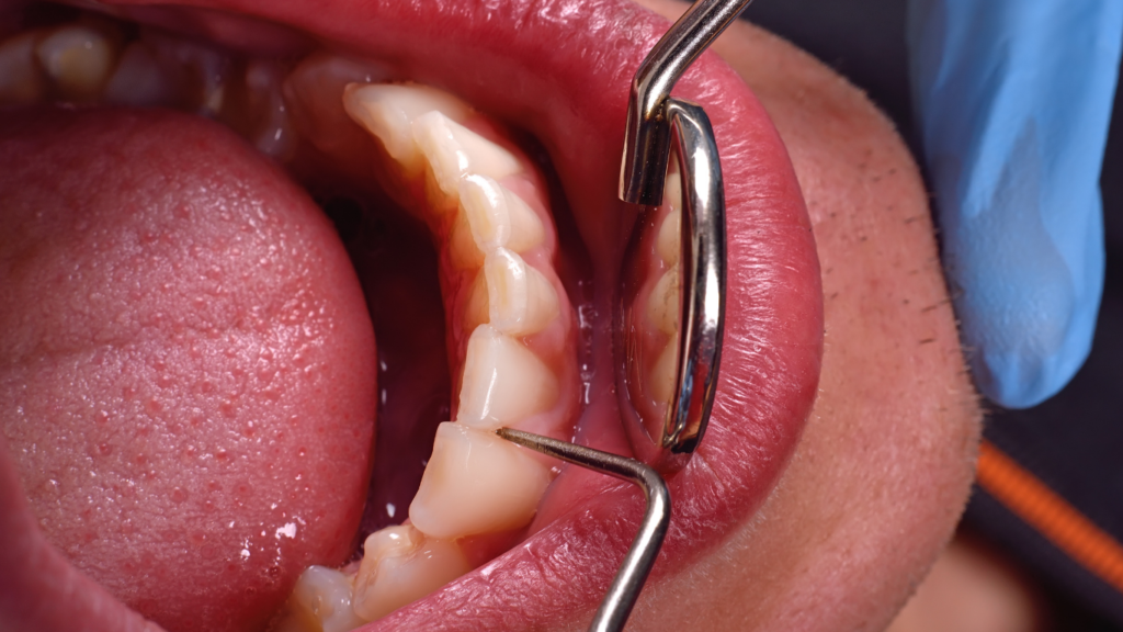 17 Mouth and Tongue Medical Conditions Symptoms Causes Treatment Preventions