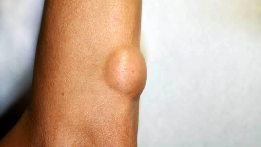 Lipoma (Skin Lumps) Symptoms Causes Treatment Preventions - Symptom Clinic