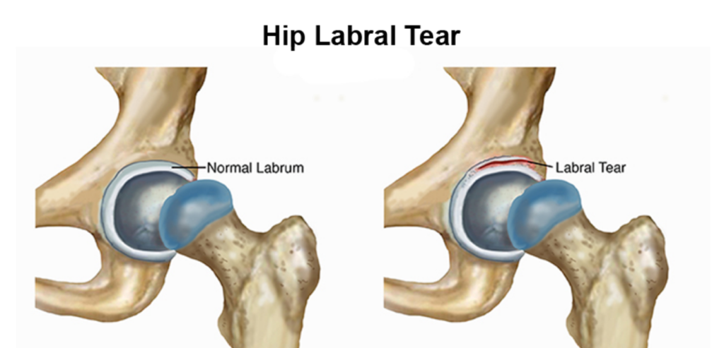Hip Labral tear Symptoms Causes Treatment Preventions