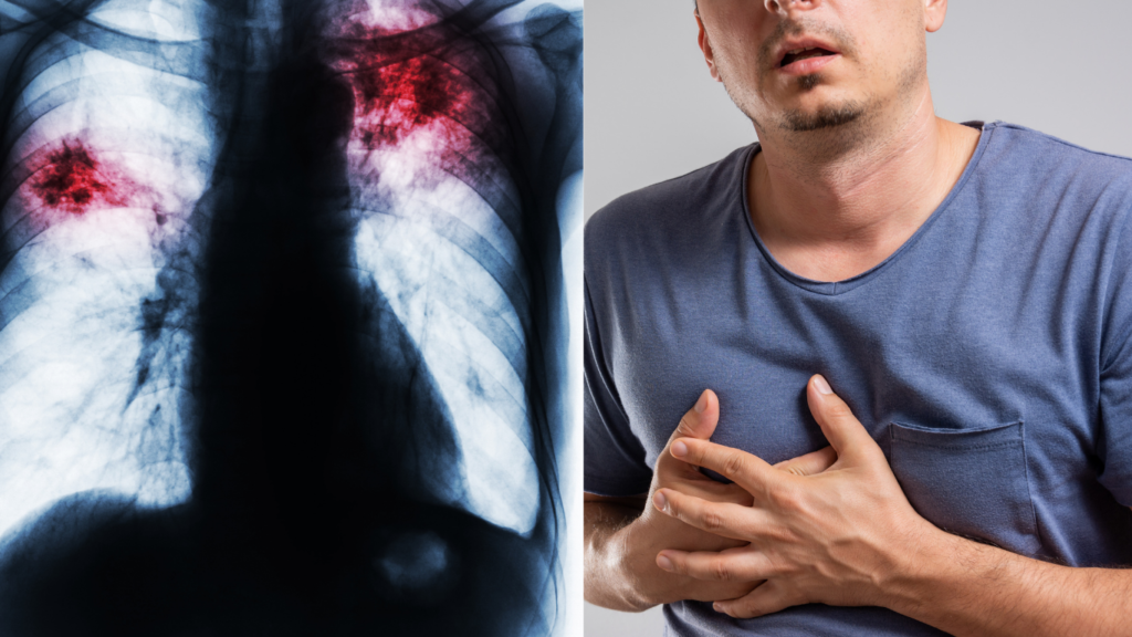 Pulmonary Embolism Symptoms Causes Treatment Preventions 