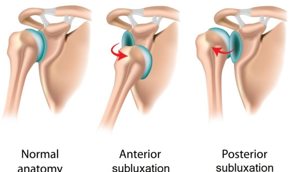 Shoulder Subluxation Symptoms Causes Treatment Preventions