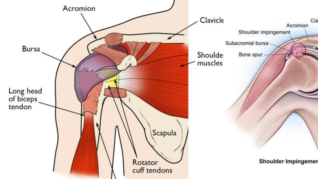 Subacromial Shoulder Impingement & Bursitis Symptoms Causes
